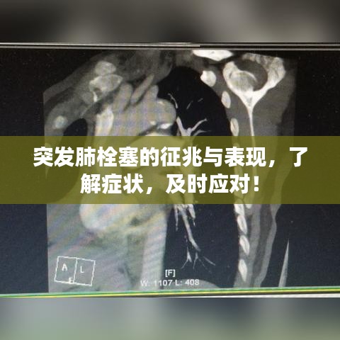 突发肺栓塞的征兆与表现，了解症状，及时应对！